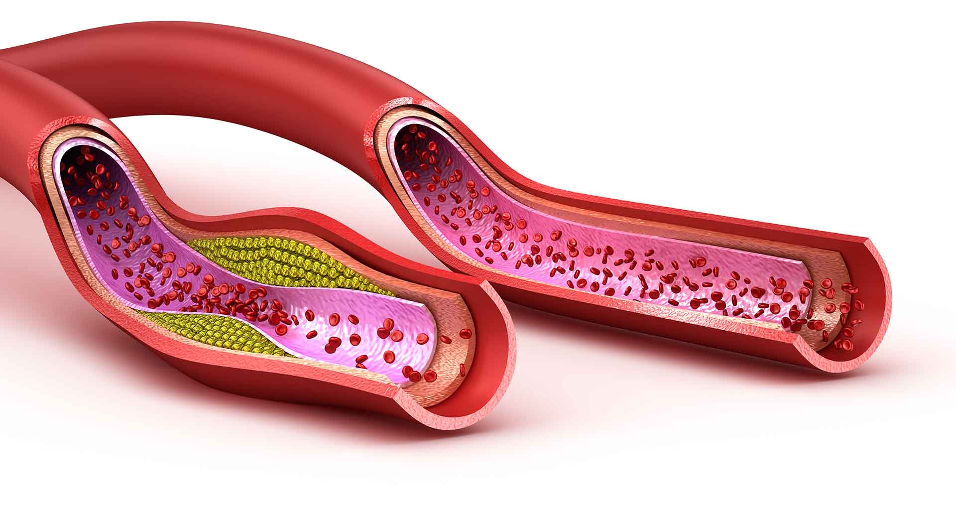 How to Reduce Cholesterol